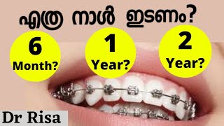 Pallil Kambi Idunnath Yethranaal Braces  How Long to Wear Braces Malayalam  pallil kambi [upl. by Akeem]