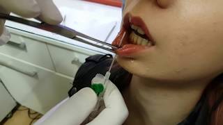 Anesthesia  Labret  Dudak Piercing Delimi [upl. by Carmelo]