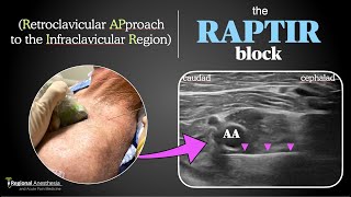 RAPTIR block Retroclavicular Approach to the Infraclavicular Region [upl. by Inge]