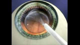 Explication Chirurgie refractive ICL Implant intraoculaire [upl. by Bear]