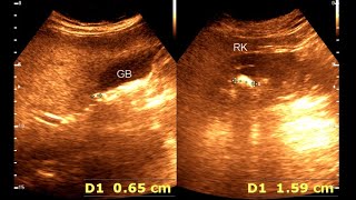 Fatty Liver  Cholelithiasis Renal stone ultrasonography [upl. by Eniluqaj]