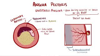 Angina pectoris stable unstable prinzmetal vasospastic symptoms amp pathology [upl. by Yhotmit]