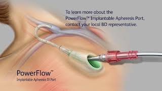 PowerFlow Implantable Apheresis IV Port Access Video [upl. by Rodi]