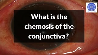 What is Conjunctival Chemosis [upl. by Alakcim]