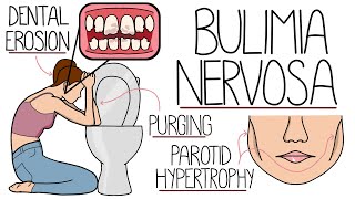 Understanding Bulimia Bulimia Nervosa Explained Clearly [upl. by Siegel473]