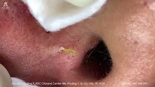 Big Cystic Acne Blackheads Extraction Blackheads amp Milia Whiteheads Removal Pimple Popping [upl. by Luciana]