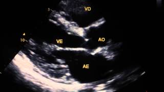 Disfuncao ventricular moderada  fe 40 [upl. by Murray415]