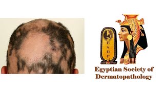 Trichoscopy of Alopecia Areata AA Dr Mohamed Samir Consultant Dermatologist [upl. by Yendys]