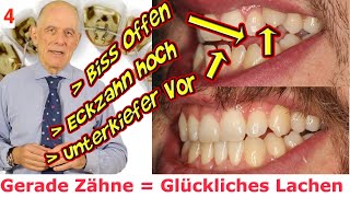 Misssion Gerade Zähne Glückliches Lachen Nr4 Offener Biss hochstehender Eckzahn UkVorbiss [upl. by Assenaj953]