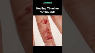 Wound Healing Explained Stages Factors and Tips for Recovery [upl. by Mala]