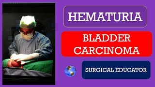 BLADDER CARCINOMA How To DIAGNOSE amp TREAT  HEMATURIA [upl. by Calandra271]