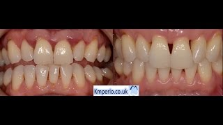 Treatment of Advanced Periodontal Gum Disease [upl. by Arihsat827]