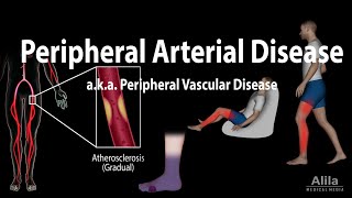 Peripheral artery disease Pathophysiology Causes Symptoms Diagnosis and Treatments Animation [upl. by Esenaj]