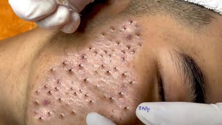 Best of Blackheads Remover [upl. by O'Kelly275]