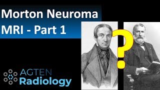 Who really described Mortons Neuroma first [upl. by Tuck]