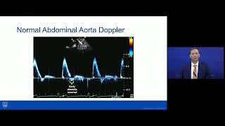 Coarctation of the AortaImaging and Management [upl. by Juliano]