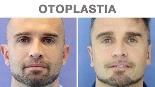 Otoplastia antes y después  Testimonio de David [upl. by Veriee543]