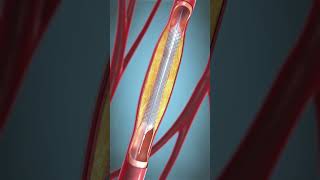 procedure of angioplasty shorts viralshorts [upl. by Sidoma442]