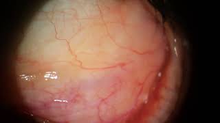 Prolapsed Orbital Fat and Conjunctival Cysts with Concretions [upl. by Nalyt]