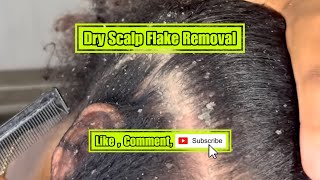 Dry scalp Flake removal [upl. by Edwina543]