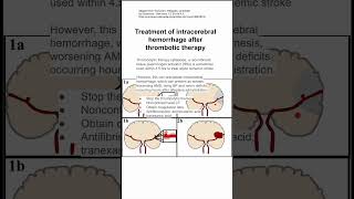 Treatment of intracerebral hemorrhage after thrombotic therapy [upl. by Lulita]