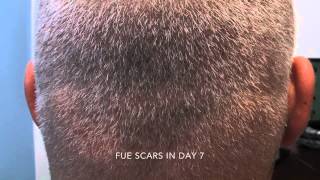 Scars from FUE and strip method [upl. by Myriam]