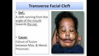 Developmental Disturbances of The Soft Tissues part1Oral Pathologywmv [upl. by Anibas]