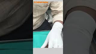 How Lignocaine Is Given Xylocaine कैसे दिया जाता है drsubhashkumar anaesthesia [upl. by Paschasia]