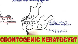 Odontogenic Keratocyst  Clinical Radiographic and Histopathologic Features [upl. by Ahsurej714]