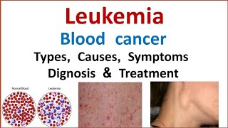 Leukemia  Blood cancer  Types Causes Symptoms Treatment [upl. by Shippee398]