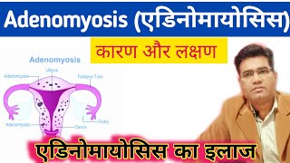 What are Adenomyosis Causes Symptoms and Treatment  एडिनोमायोसिस का इलाज [upl. by Hylton]