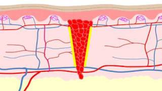 Physiology of wound healing [upl. by Kcub]