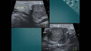 Mucoepidermoid carcinoma 점액표피양 암종침샘암 [upl. by Cati965]