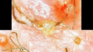 Ingrown Pili Multigemini Blackhead COMBO Very Unique and Satisfying [upl. by Redan]