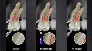 ProTaper Next™ – Canal Preparation with Dr Peet van Der Vyver  Dentsply Sirona [upl. by Kcirnek475]