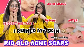 Remove and get rid of Deep Acne Scars amp Dark Spots  Micro needling Experience and their Treatments [upl. by Suryc]