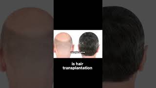 Revolutionary Hair Restoration Techniques [upl. by Sivrep]