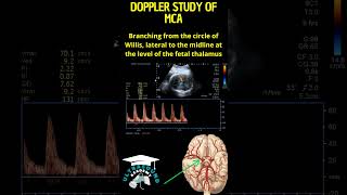 Quick Guide Doppler Ultrasound of the Fetal Middle Cerebral Artery [upl. by Aubyn38]