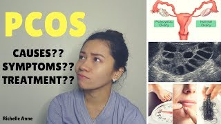 PCOS  Causes Symptoms Treatment  Tagalog [upl. by Arni]