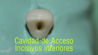 Cavidad de acceso incisivos inferiores  access cavity lower incisors [upl. by Gruber]