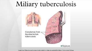 Miliary tuberculosis [upl. by Eugenle]