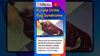 Purple Urine Bag Syndrome nursing doctor medical [upl. by Gati]