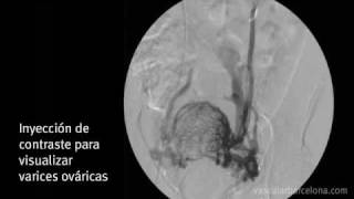 Tratamiento síndrome congestivo pélvico · VASCULAR Barcelona [upl. by Ormand]