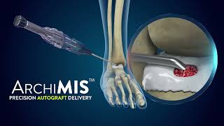 ArchiMIS  Precision Autograft Delivery  Launch Video [upl. by Ruzich]