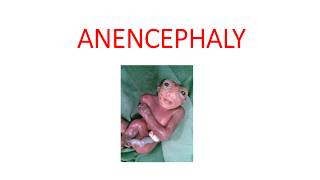 ANENCEPHALY [upl. by Aihsekram567]