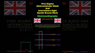 Electrocardiography  First Degree Atrioventricular Block And Intermittent Right Bundle Branch Block [upl. by Aznarepse]