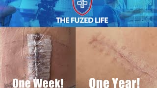 The Truth About Scars and Spinal Fusion  Healing Time Unsightly [upl. by Jocelyne]