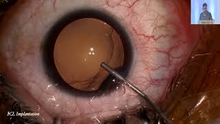 AIOC2024 GP28 Topic Dr Ashvin Agarwal ICL surgery complications [upl. by Gavra493]