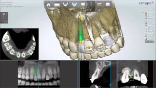 Dental System 2013  Implant Planning and Guided Surgery [upl. by Jim]