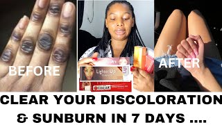 MY TOP 4 WHITENING GEL TUBE FOR DISCOLORATION amp SUNBURN Visible result in 7 daysviralvideo [upl. by Jacobba]